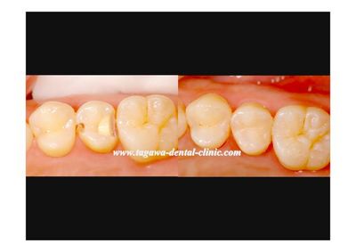 両隣接面の虫歯をダイレクトボンディングで治療した症例